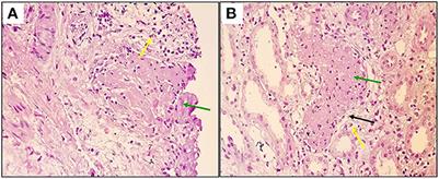 Case report: A case of renal arcuate vein thrombosis successfully treated with direct oral anticoagulants